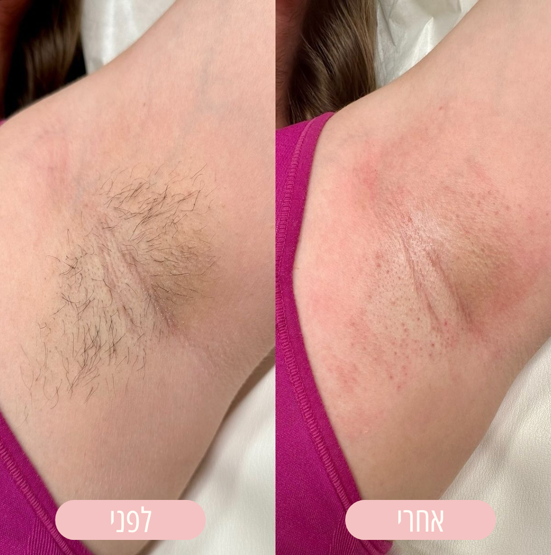 NOVELA – מכונת גילוח עדינה לעור חלק וללא גירויים